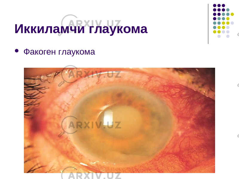 Иккиламчи глаукома  Факоген глаукома 
