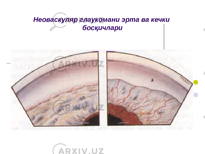 Неоваскуляр глаукомани эрта ва кечки бос қ ичлари 