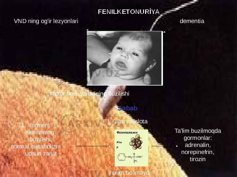 FENILKETONURİYA VND ning og&#39;ir lezyonlari dementia Motor boshqaruvining buzilishi Sabab 1. ferment sintezining buzilishi, normal metabolizm uchun zarur hazm bo&#39;lmaydi Ta&#39;lim buzilmoqda gormonlar: adrenalin, norepinefrin, tirozinaminokislota 