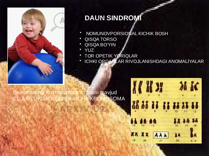 DAUN SINDROMI • NOMUNOVPORSIONAL KICHIK BOSH • QISQA TORSO • QISQA BO&#39;YIN • YUZ • TOR OPETIK YORIQLAR • ICHKI ORGANLAR RIVOJLANISHDAGI ANOMALİYALAR Bemorlarning Xromosomalar to&#39;plami mavjud 21-JUFTLIKDAGI QO&#39;SHIMCHA XROMOSOMA 