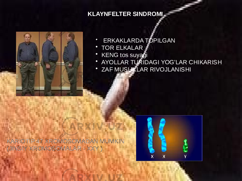 KLAYNFELTER SINDROMI • ERKAKLARDA TOPILGAN • TOR ELKALAR • KENG tos suyagi • AYOLLAR TURIDAGI YOG&#39;LAR CHIKARISH • ZAF MUSUKLAR RIVOJLANISHI KARIOTIP 47 XROMOSOMADAN MUMKIN (JINSIY XROMOSOMALAR - XXY ) 