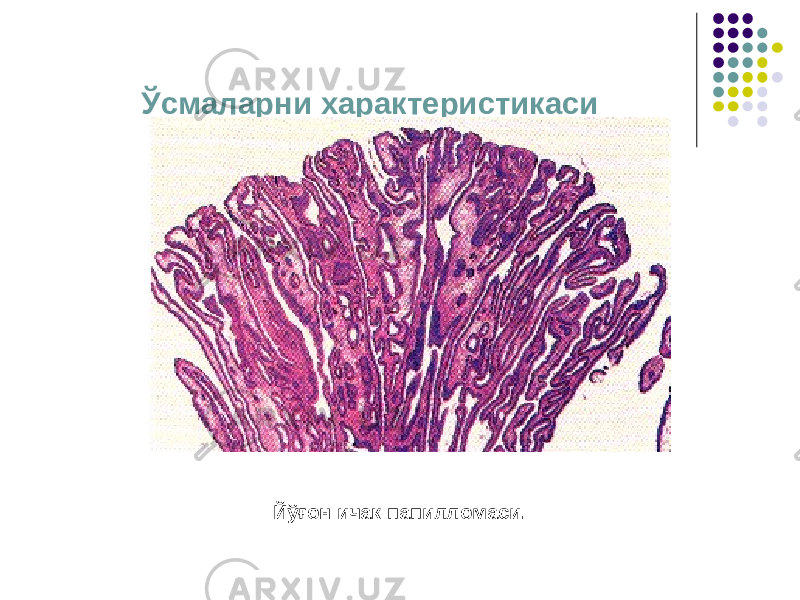 Ўсмаларни характеристикаси Йўғон ичак папилломаси. 