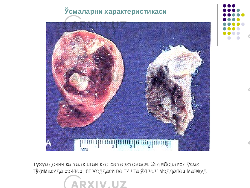 Ўсмаларни характеристикаси Тухумдонни катталашган кистоз тератомаси. Эътиборлиси ўсма тўқимасида сочлар, ёғ моддаси ва тишга ўхшаш моддалар мавжуд. 