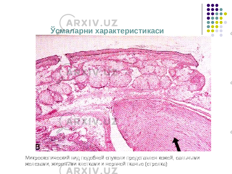 Ўсмаларни характеристикаси Микроскопический вид подобной опухоли представлен кожей, сальными железами, жировыми клетками и нервной тканью (стрелка) 