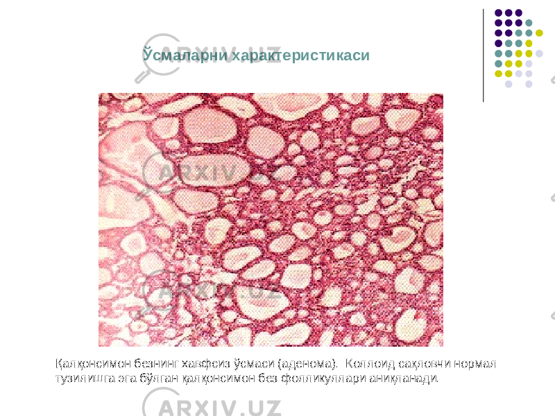 Ўсмаларни характеристикаси Қалқонсимон безнинг хавфсиз ўсмаси (аденома). Коллоид сақловчи нормал тузилишга эга бўлган қалқонсимон без фолликуллари аниқланади. 