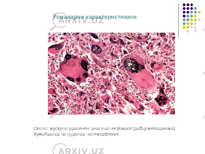 Ўсмаларни характеристикаси Скелет мускулатурасининг анапластик ўсмаси (рабдомиосаркома). Хужайралар ва ядролар полиморфизми 