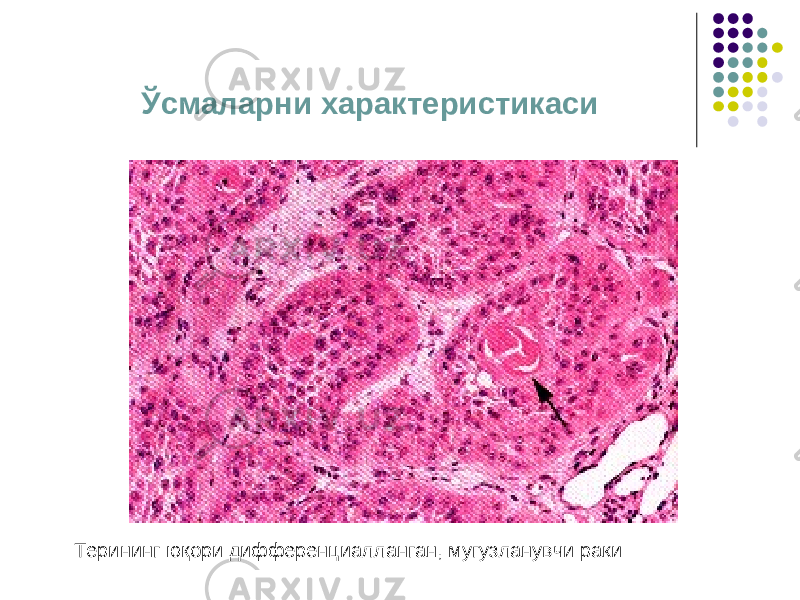 Ўсмаларни характеристикаси Терининг юқори дифференциалланган, мугузланувчи раки 