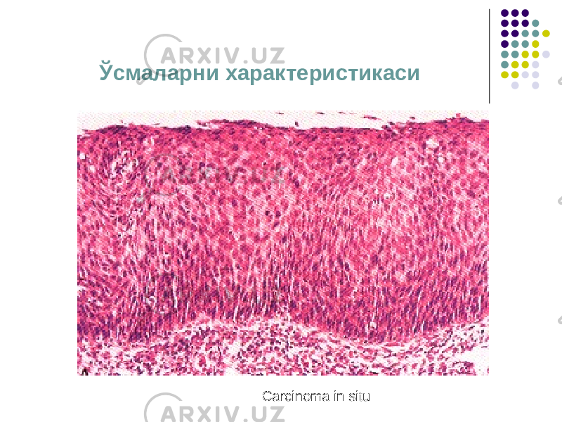 Ўсмаларни характеристикаси Carcinoma in situ 