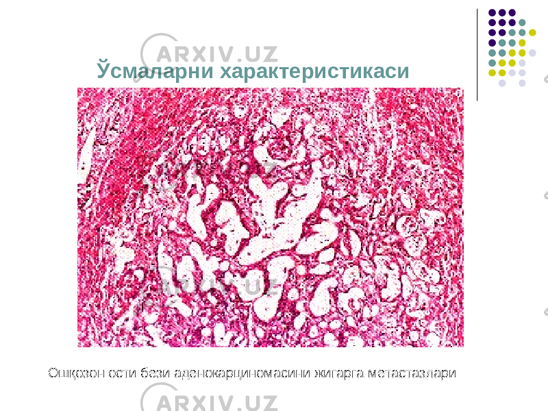 Ўсмаларни характеристикаси Ошқозон ости бези аденокарциномасини жигарга метастазлари 