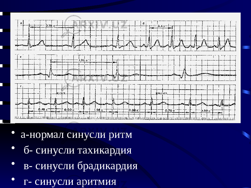 • а-нормал синусли ритм • б- синусли тахикардия • в- синусли брадикардия • г- синусли аритмия 