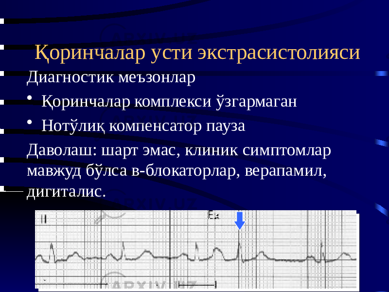 Қоринчалар усти экстрасистолияси Диагностик меъзонлар • Қоринчалар комплекси ўзгармаган • Нотўлиқ компенсатор пауза Даволаш: шарт эмас, клиник симптомлар мавжуд бўлса в-блокаторлар, верапамил, дигиталис. 