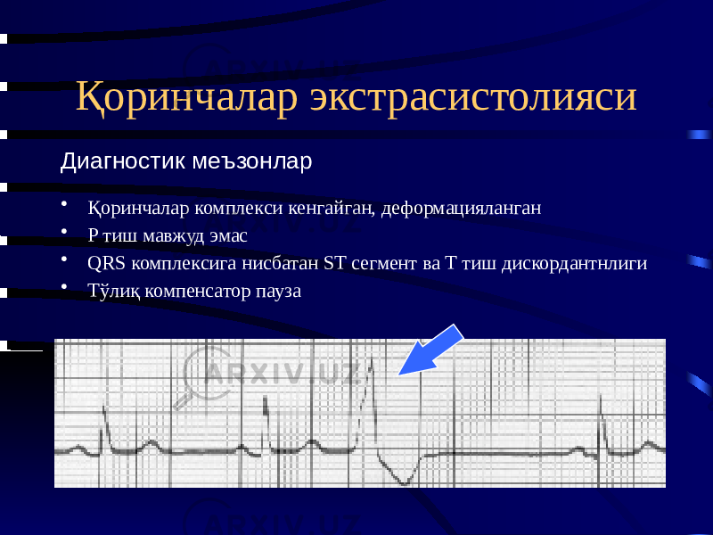 Қоринчалар экстрасистолияси • Қоринчалар комплекси кенгайган, деформацияланган • P тиш мавжуд эмас • QRS комплексига нисбатан ST сегмент ва T тиш дискордантнлиги • Тўлиқ компенсатор паузаДиагностик меъзонлар 