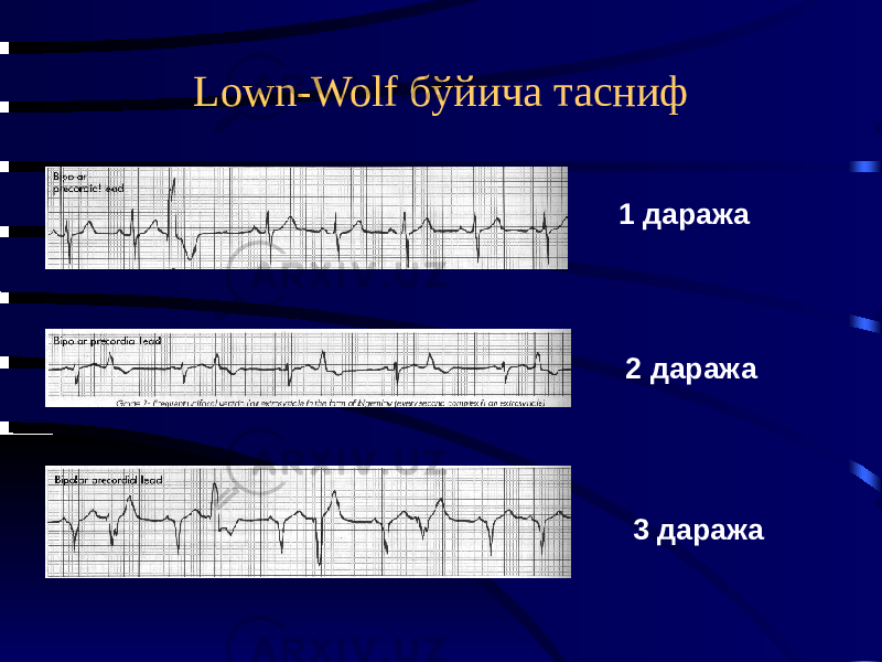 Lown-Wolf бўйича тасниф 1 даража 2 даража 3 даража 