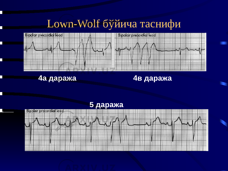 Lown-Wolf бўйича таснифи 4а даража 4в даража 5 даража 