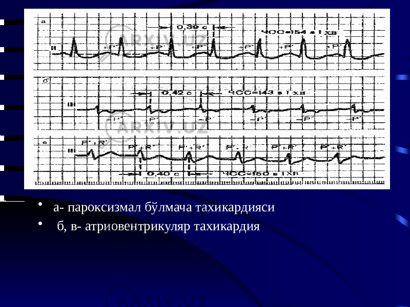 • а- пароксизмал бўлмача тахикардияси • б, в- атриовентрикуляр тахикардия 