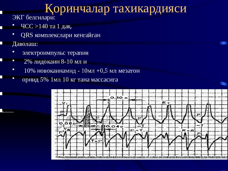 Қоринчалар тахикардияси ЭКГ белгилари: • ЧСС >140 та 1 дақ. • QRS комплекслари кенгайган Даволаш: • электроимпульс терапия • 2% лидокаин 8-10 мл и • 10% новокаинамид - 10мл +0,5 мл мезатон • орнид 5% 1мл 10 кг тана массасига 