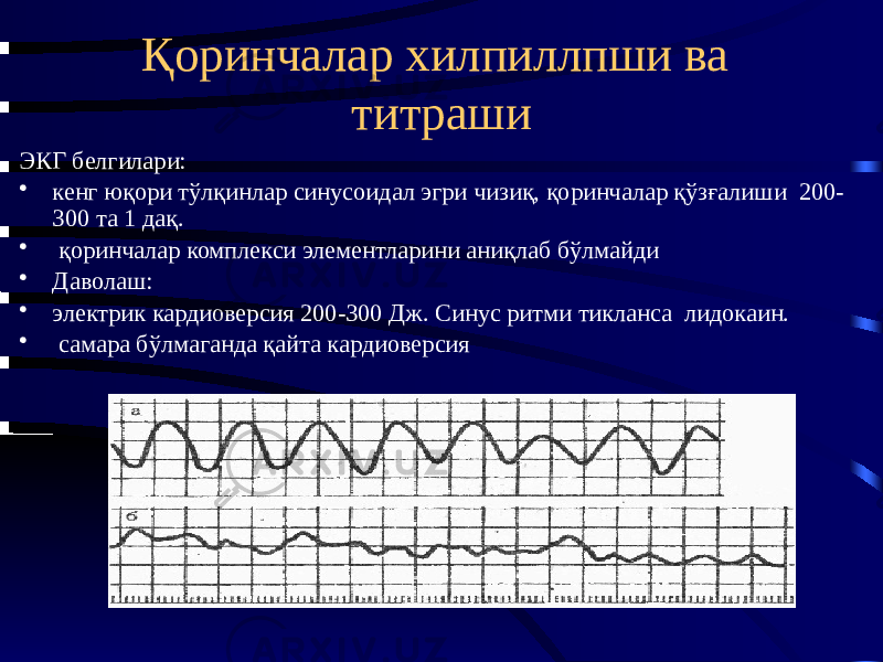 Қоринчалар хилпиллпши ва титраши ЭКГ белгилари: • кенг юқори тўлқинлар синусоидал эгри чизиқ, қоринчалар қўзғалиши 200- 300 та 1 дақ. • қоринчалар комплекси элементларини аниқлаб бўлмайди • Даволаш: • электрик кардиоверсия 200-300 Дж. Синус ритми тикланса лидокаин. • самара бўлмаганда қайта кардиоверсия 