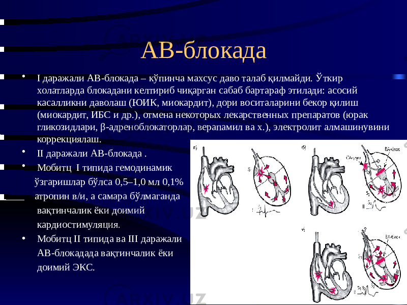 АВ-блокада • I даражали АВ-блокада – кўпинча махсус даво талаб қилмайди. Ўткир холатларда блокадани келтириб чиқарган сабаб бартараф этилади: асосий касалликни даволаш (ЮИК, миокардит), дори воситаларини бекор қилиш (миокардит, ИБС и др.), отмена некоторых лекарственных препаратов (юрак гликозидлари, β-адреноблокаторлар, верапамил ва х.), электролит алмашинувини коррекциялаш. • II даражали АВ-блокада . • Мобитц I типида гемодинамик ўзгаришлар бўлса 0,5–1,0 мл 0,1% атропин в/и, а самара бўлмаганда вақтинчалик ёки доимий кардиостимуляция. • Мобитц II типида ва III даражали АВ-блокадада вақтинчалик ёки доимий ЭКС. 