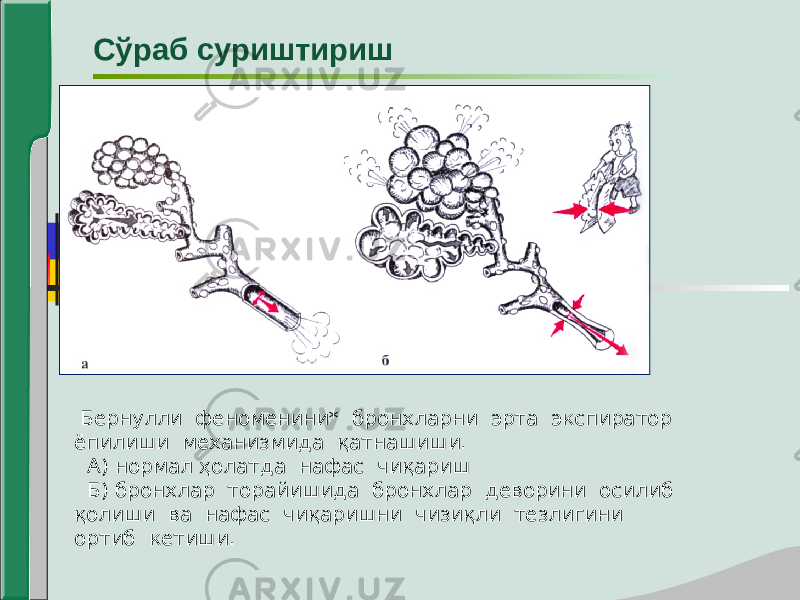 Сўраб суриштириш Бернулли феноменини* бронхларни эрта экспиратор ёпилиши механизмида қатнашиши. А) нормал ҳолатда нафас чиқариш Б) бронхлар торайишида бронхлар деворини осилиб қолиши ва нафас чиқаришни чизиқли тезлигини ортиб кетиши. 