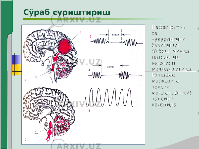 Сўраб суриштириш Нафас ритми ва чуқурлигини бузилиши: А) бош мияда патологик жарайён мавжудлигида, Б) нафас марказига токсик моддаларни(2) таъсири ҳолатида 