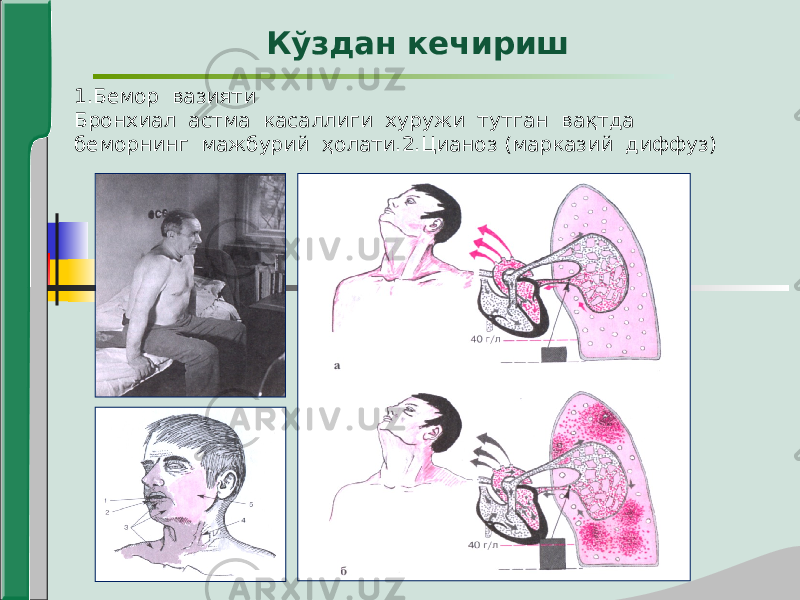 Кўздан кечириш 1.Бемор вазияти Бронхиал астма касаллиги хуружи тутган вақтда беморнинг мажбурий ҳолати.2.Цианоз (марказий диффуз) 