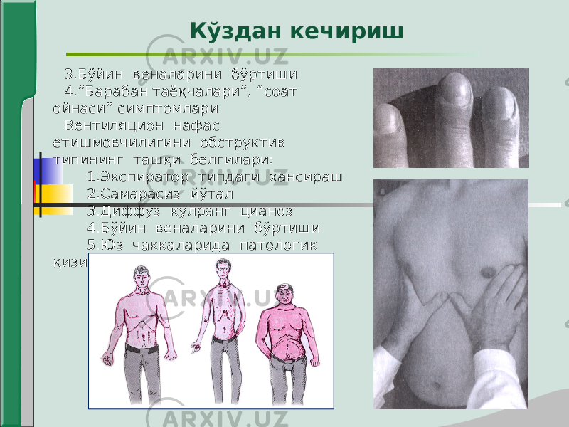 3.Бўйин веналарини бўртиши 4.”Барабан таёқчалари”, “соат ойнаси” симптомлари Вентиляцион нафас етишмовчилигини обструктив типининг ташқи белгилари: 1.Экспиратор типдаги хансираш 2.Самарасиз йўтал 3.Диффуз кулранг цианоз 4.Бўйин веналарини бўртиши 5.Юз чаккаларида патологик қизиллик Кўздан кечириш 