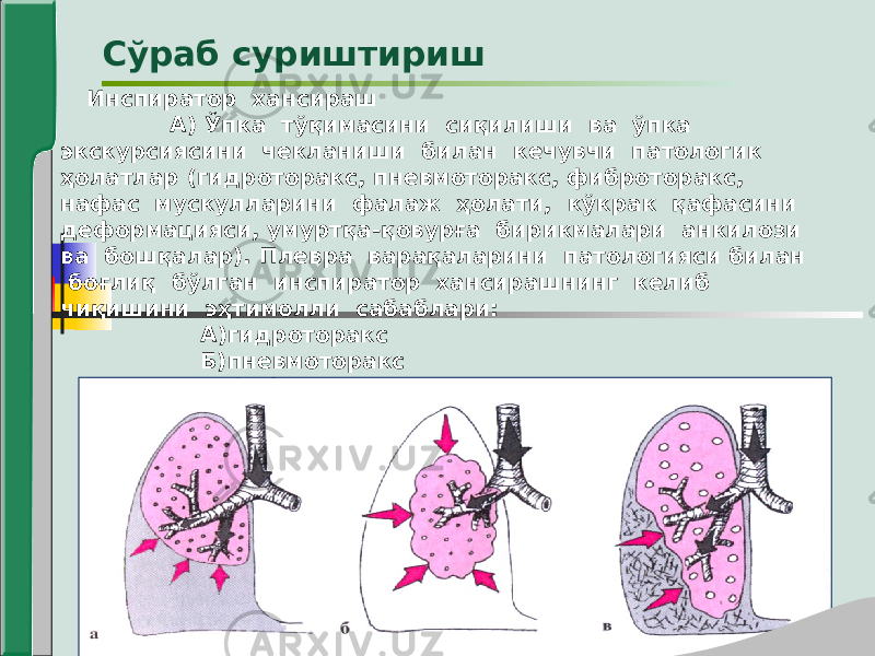 Инспиратор хансираш А) Ўпка тўқимасини сиқилиши ва ўпка экскурсиясини чекланиши билан кечувчи патологик ҳолатлар (гидроторакс, пневмоторакс, фиброторакс, нафас мускулларини фалаж ҳолати, кўкрак қафасини деформацияси, умуртқа-қовурға бирикмалари анкилози ва бошқалар). Плевра варақаларини патологияси билан боғлиқ бўлган инспиратор хансирашнинг келиб чиқишини эҳтимолли сабаблари: А)гидроторакс Б)пневмоторакс В)фибротораксСўраб суриштириш 