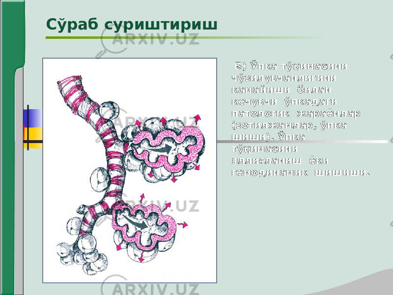  Б) Ўпка тўқимасини чўзилувчанлигини камайиши билан кечувчи ўпкадаги патологик жараёнлар (зотилжамлар, ўпка шиши). Ўпка тўқимасини яллиғланиш ёки гемодинамик шишиши. Сўраб суриштириш 