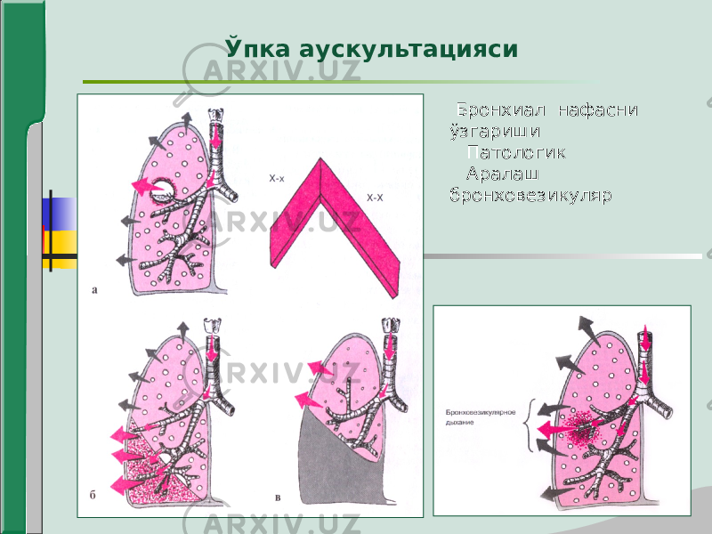  Бронхиал нафасни ўзгариши Патологик Аралаш бронховезикуляр Ўпка аускультацияси 