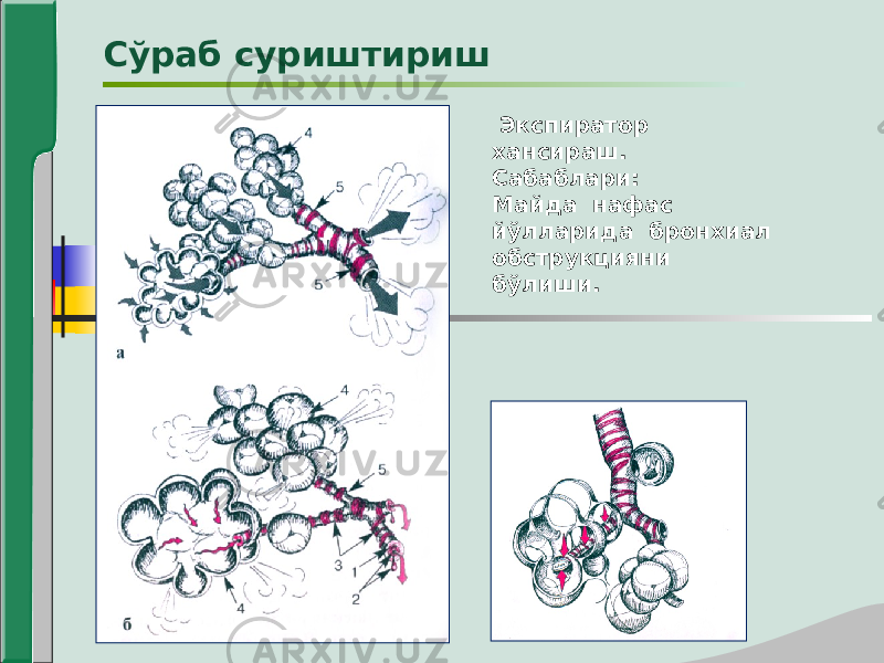  Экспиратор хансираш. Сабаблари: Майда нафас йўлларида бронхиал обструкцияни бўлиши.Сўраб суриштириш 