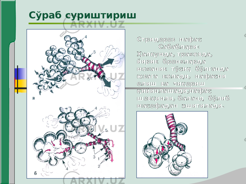 Стридороз нафас Сабаблари: Ҳалқумда, трахеяда, йирик бронхларда механик тўсиқ бўлганда юзага келади, нафасни олиш ва чиқориш қийинлашади,нафас шовқинли, баланд бўлиб масофадан эшитилади.Сўраб суриштириш 