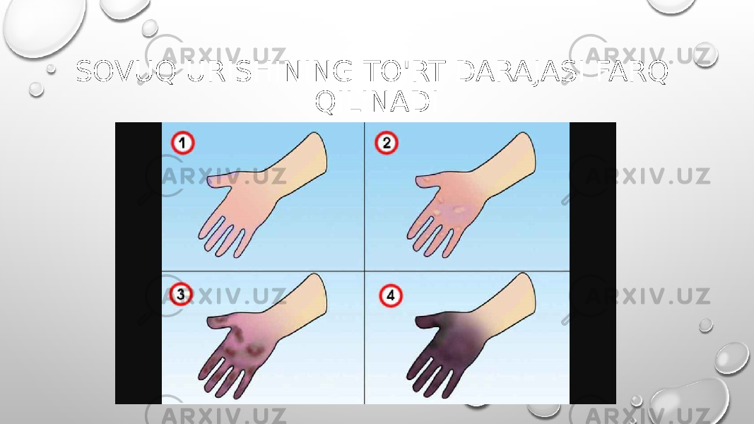 SOVUQ URISHINING TO&#39;RT DARAJASI FARQ QILINADI 