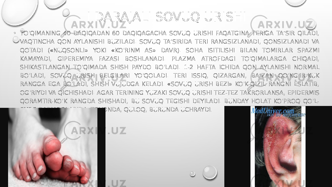 I DARAJALI SOVUQ URISHI • TO&#39;QIMANING 40 DAQIQADAN 60 DAQIQAGACHA SOVUQ URISHI FAQATGINA TERIGA TA’SIR QILADI, VAQTINCHA QON AYLANISHI BUZILADI. SOVUQ TA’SIRIDA TERI RANGSIZLANADI, QONSIZLANADI VA QOTADI («NUQSONLI» YOKI «KO&#39;RINM AS» DAVR). SOHA ISITILISHI BILAN TOMIRLAR SPAZMI KAMAYADI, GIPEREMIYA FAZASI BOSHLANADI. PLAZMA ATROFDAGI TO&#39;QIMALARGA CHIQADI, SHIKASTLANGAN TO&#39;QIMADA SHISH PAYDO BO&#39;LADI. 1-2 HAFTA ICHIDA QON AYLANISHI NORMAL BO&#39;LADI, SOVUQ URISH BELGILARI YO&#39;QOLADI. TERI ISSIQ, QIZARGAN, BA’ZAN QO&#39;NG&#39;IR-KUK RANGGA EGA BO&#39;LADI, SHISH VUJUDGA KELADI. «SOVUQ URISH BEZI» KO&#39;K-QIZIL RANGNI ESLATIB, OG&#39;RIYDI VA QICHISHADI. AGAR TERINING YUZAKI SOVUQ URISHI TEZ-TEZ TAKRORLANSA, EPIDERMIS QORAMTIR-KO&#39;K RANGDA SHISHADI, BU SOVUQ TEGISHI DEYILADI. BUNDAY HOLAT KO&#39;PROQ QO&#39;L- OYOQ BARMOQLARIDA, TOVONDA, QULOQ, BURUNDA UCHRAYDI . 