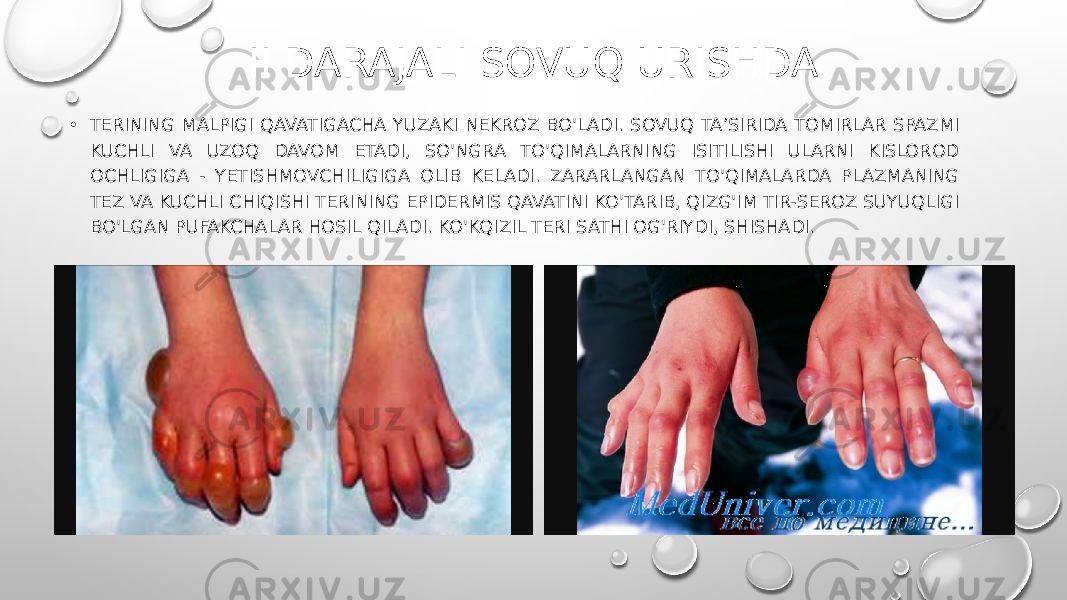 II DARAJALI SOVUQ URISHDA • TERINING MALPIGI QAVATIGACHA YUZAKI NEKROZ BO&#39;LADI. SOVUQ TA’SIRIDA TOMIRLAR SPAZMI KUCHLI VA UZOQ DAVOM ETADI, SO&#39;NGRA TO&#39;QIMALARNING ISITILISHI ULARNI KISLOROD OCHLIGIGA - YETISHMOVCHILIGIGA OLIB KELADI. ZARARLANGAN TO&#39;QIMALARDA PLAZMANING TEZ VA KUCHLI CHIQISHI TERINING EPIDERMIS QAVATINI KO&#39;TARIB, QIZG&#39;IM TIR-SEROZ SUYUQLIGI BO&#39;LGAN PUFAKCHALAR HOSIL QILADI. KO&#39;KQIZIL TERI SATHI OG&#39;RIYDI, SHISHADI. 