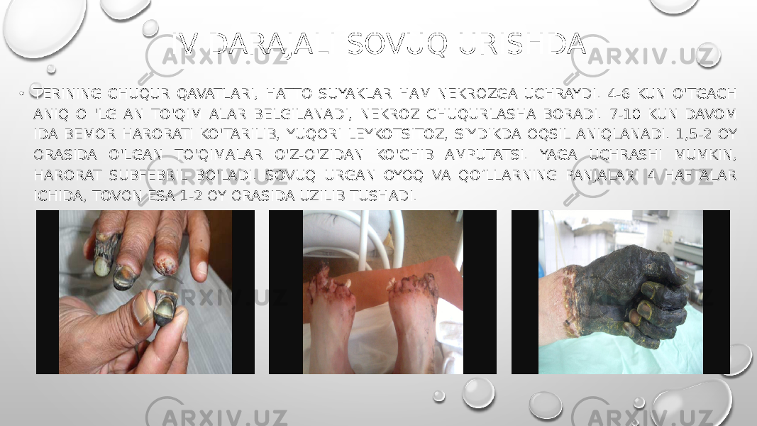 IV DARAJALI SOVUQ URISHDA • TERINING CHUQUR QAVATLARI, HATTO SUYAKLAR HAM NEKROZGA UCHRAYDI. 4-6 KUN O&#39;TGACH ANIQ O &#39;LG AN TO&#39;QIM ALAR BELGILANADI, NEKROZ CHUQURLASHA BORADI. 7-10 KUN DAVOM IDA BEMOR HARORATI KO&#39;TARILIB, YUQORI LEYKOTSITOZ, SIYDIKDA OQSIL ANIQLANADI. 1,5-2 OY ORASIDA O&#39;LGAN TO&#39;QIMALAR O&#39;Z-O&#39;ZIDAN KO&#39;CHIB AMPUTATSI. YAGA UCHRASHI MUMKIN, HARORAT SUBFEBRIL BO&#39;LADI. SOVUQ URGAN OYOQ VA QO‘LLARNING PANJALARI 4 HAFTALAR ICHIDA, TOVON ESA 1-2 OY ORASIDA UZILIB TUSHADI. 