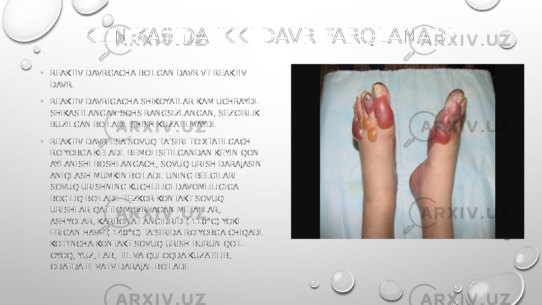 KLINIKASIDA IKKI DAVR FARQLANADI: • REAKTIV DAVRGACHA BO&#39;LGAN DAVR VT REAKTIV DAVR. • REAKTIV DAVRIGACHA SHIKOYATLAR KAM UCHRAYDI. SHIKASTLANGAN SOHS RANGSIZLANGAN, SEZGIRLIK BUZILGAN BO&#39;LADI. SHISH KUZATILMAYDI. • REAKTIV DAVR ESA SOVUQ TA’SIRI TO&#39;XTATILGACH RO&#39;YOBGA KELADI. BEMOI ISITILGANDAN KEYIN QON AYLANISHI BOSHLANGACH, SOVUQ URISH DARAJASIN ANIQLASH MUMKIN BO&#39;LADI. UNING BELGILARI SOVUQ URISHNING KUCHLILIGI DAVOMLILIGIGA BOG&#39;LIQ BO&#39;LADI. TEZKOR KONTAKT SOVUQ URISHLAR QATTIC MUZRLAGAN METALLAR, ASHYOLAR, KARBONAT ANGIDRID (-110°C) YOKI ERIGAN HAVE (-140°C) TA’SIRIDA RO&#39;YOBGA CHIQADI. KO&#39;PINCHA KONTAKT SOVUQ URISH BURUN QO&#39;L- OYOQ, YUZ, LAB, TIL VA QULOQDA KUZATILIB, ODATDA III VA IV DARAJAL BO&#39;LADI. 