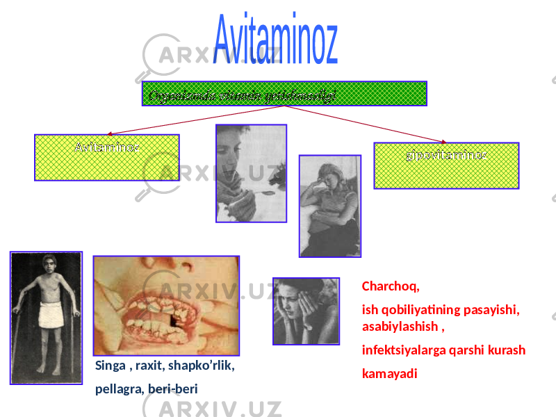 Organizmda vitamin yetishmasligi Аvitaminoz gipovitaminoz Singa , raxit, shapko’rlik, pellagra, beri-beri Charchoq, ish qobiliyatining pasayishi, asabiylashish , infektsiyalarga qarshi kurash kamayadi 