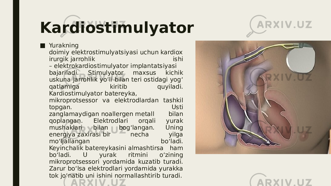 Kardiostimulyator ■ Yurakning doimiy elektrostimulyatsiyasi uchun kardiox irurgik jarrohlik ishi – elektrokardiostimulyator implantatsiyasi bajariladi. Stimulyator maxsus kichik uskuna jarrohlik yo‘li bilan teri ostidagi yog‘ qatlamiga kiritib quyiladi. Kardiostimulyator batereyka, mikroprotsessor va elektrodlardan tashkil topgan. Usti zanglamaydigan noallergen metall bilan qoplangan. Elektrodlari orqali yurak mushaklari bilan bog‘langan. Uning energiya zaxirasi bir necha yilga mo‘ljallangan bo‘ladi. Keyinchalik batereykasini almashtirsa ham bo‘ladi. U yurak ritmini o‘zining mikroprotsessori yordamida kuzatib turadi. Zarur bo‘lsa elektrodlari yordamida yurakka tok jo‘natib uni ishini normallashtirib turadi. 