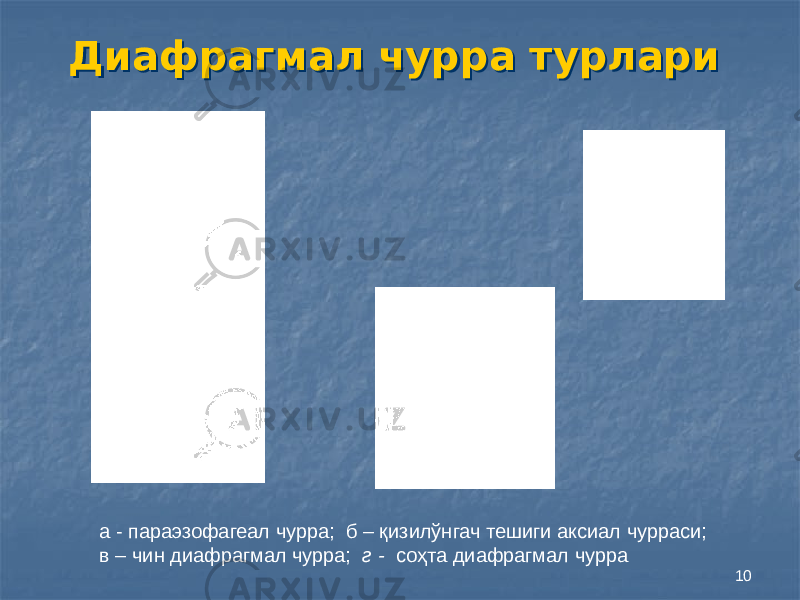 10Диафрагмал чурра турлариДиафрагмал чурра турлари а - параэзофагеал чурра; б – қизилўнгач тешиги аксиал чурраси; в – чин диафрагмал чурра; г - соҳта диафрагмал чурра 