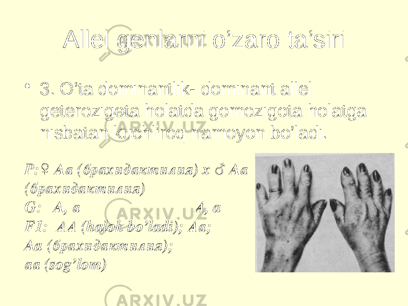 Allel genlarni o’zaro ta’siri • 3. O’ta dominantlik- dominant allel geterozigota holatda gomozigota holatga nisbatan kuchliroq namoyon bo’ladi. P:♀ Aа (брахидактилия) x ♂ Aа (брахидактилия) G: A, а А, a F1: АА (halok bo’ladi); Аа; Aa (брахидактилия); аа (sog’lom) 