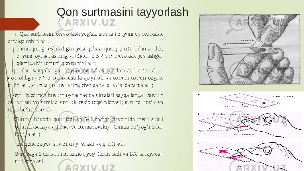 Qon surtmasini tayyorlash Qon surtmasini tayyorlash yog&#39;siz shishali buyum oynachasida amalga oshiriladi. - barmoqning teshiladigan yostiqchasi quruq paxta bilan artilib, buyum oynachasining chetidan 1,5-2 sm masofada joylashgan qismiga bir tomchi qon tomiziladi; - qirralari sayqallangan buyum oynachasi yordamida bir tomchi qon oldiga 45 ° burchak ostida qo&#39;yiladi va tomchi tomon ozgina siljitiladi, shunda qon oynaning chetiga teng ravishda tarqaladi; - keyin bosimsiz buyum oynachasida qirralari sayqallangan buyum oynachasi yordamida qon bir tekis taqsimlanadi; surtma nozik va tekis bo&#39;lishi kerak; - Surtma havoda quritiladi va 3-5 daqiqa davomida metil spirti bilan fiksatsiya qilinadi va Romanovskiy- Gimza bo’yog’i bilan bo;’yaladi; - ortiqcha bo&#39;yoq suv bilan yuviladi va quritiladi. - Surtmaga 1 tomchi immersion yog’ tomiziladi va 100 ta leykosit turi sanaladi. 