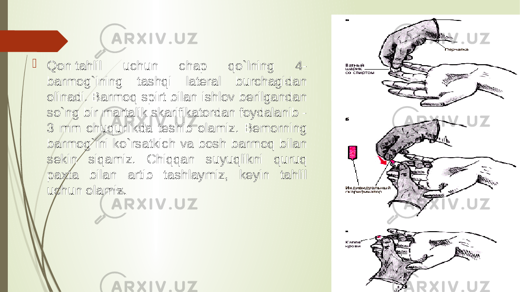  Qon tahlil uchun chap qo`lning 4- barmog`ining tashqi lateral burchagidan olinadi. Barmoq spirt bilan ishlov berilgandan so`ng bir martalik skarifikatordan foydalanib - 3 mm chuqurlikda teshib olamiz. Bemorning barmog`ini ko`rsatkich va bosh barmoq bilan sekin siqamiz. Chiqqan suyuqlikni quruq paxta bilan artib tashlaymiz, keyin tahlil uchun olamiz. 