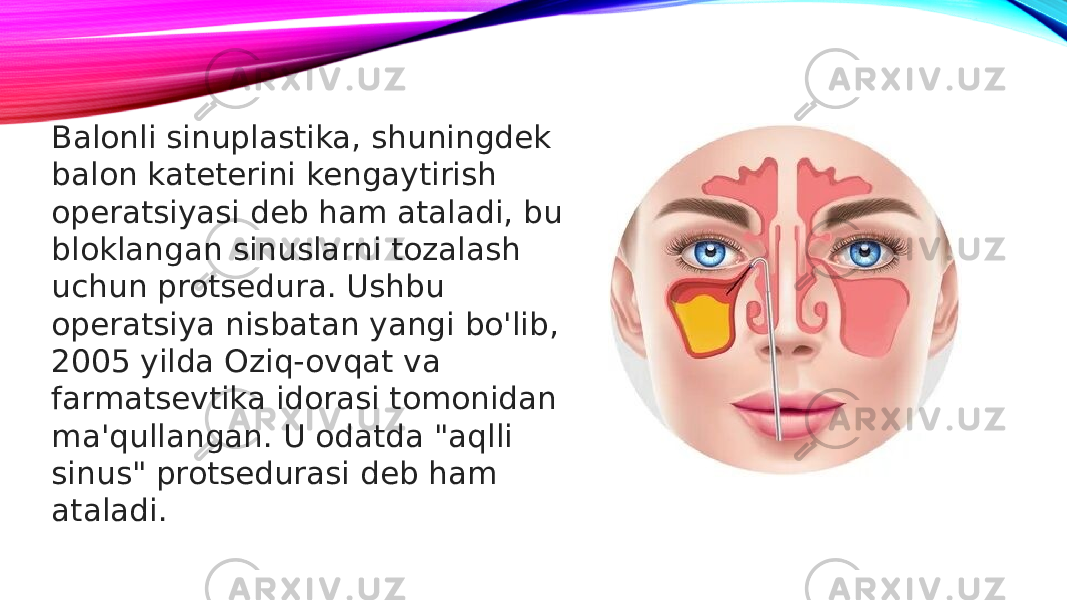 Balonli sinuplastika, shuningdek balon kateterini kengaytirish operatsiyasi deb ham ataladi, bu bloklangan sinuslarni tozalash uchun protsedura. Ushbu operatsiya nisbatan yangi bo&#39;lib, 2005 yilda Oziq-ovqat va farmatsevtika idorasi tomonidan ma&#39;qullangan. U odatda &#34;aqlli sinus&#34; protsedurasi deb ham ataladi. 