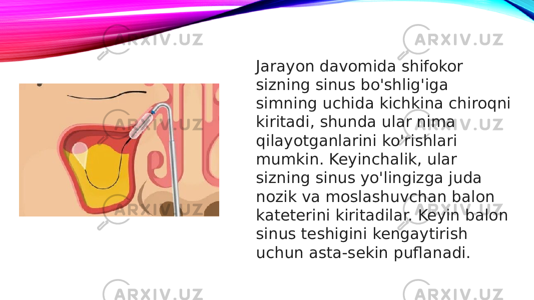 Jarayon davomida shifokor sizning sinus bo&#39;shlig&#39;iga simning uchida kichkina chiroqni kiritadi, shunda ular nima qilayotganlarini ko&#39;rishlari mumkin. Keyinchalik, ular sizning sinus yo&#39;lingizga juda nozik va moslashuvchan balon kateterini kiritadilar. Keyin balon sinus teshigini kengaytirish uchun asta-sekin puflanadi. 