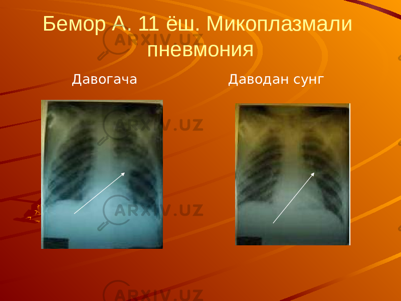 Бемор А. 11 ёш. Микоплазмали пневмония Давогача Даводан сунг 