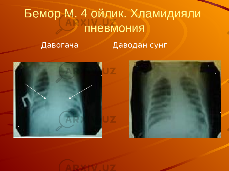 Бемор М. 4 ойлик. Хламидияли пневмония Давогача Даводан сунг 