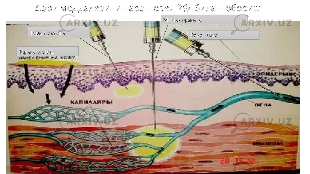  Дори моддаларини парентерал йўл билан юбориш Тери орасига Терига суртиш Мушак орасига Вена ичига 