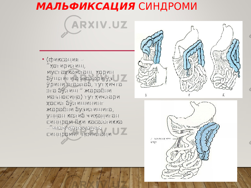 МАЛЬФИКСАЦИЯ СИНДРОМИ • (фиксация – “қотирилиш, мустаҳкамлаш, қорин бўшлиғи аъзолари ўз ўрини эгаллаб, тутқичга эга бўлиш ” жараёни маъносида) тутқичлари ҳосил бўлишининг жараёни бузилишига, ундан келиб чиқадиган синдром ёки касалликка –“ мальфиксация синдроми” дейилади 