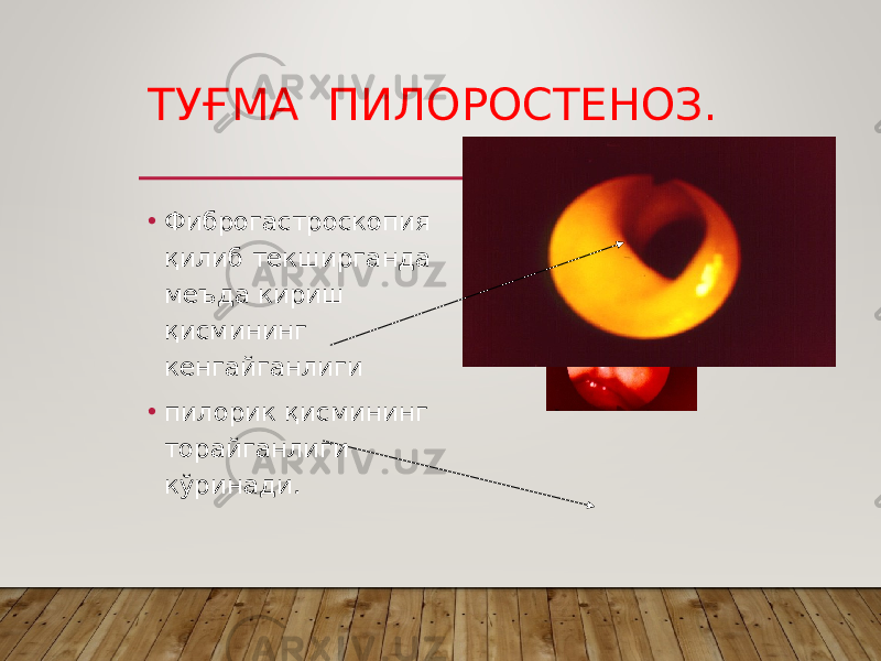 ТУҒМА ПИЛОРОСТЕНОЗ. • Фиброгастроскопия қилиб текширганда меъда кириш қисмининг кенгайганлиги • пилорик қисмининг торайганлиги кўринади. 