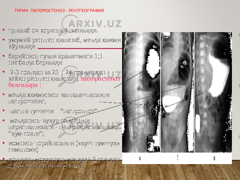 ТУҒМА ПИЛОРОСТЕНОЗ - РЕНТГЕОГРАФИЯ • эрталаб оч қоринга ўтказилади. • умумий рентген қилиниб, меъда ҳажми кўрилади • барийнинг сувли аралашмаси 1;1 нисбатда берилади • 2-3 соатдан ва 23—24 соатлардан кейин рентген қилинади. пилоростеноз белгилари : • меъда хажмининг катталашганлиги – гастрошизис, • пастга тушиши – “гастроптоз” • меъданинг чуқур сегментли перисталтикаси - гиперперистальтика, “қум соати”; • жомнинг торайганлиги («қуш тумшуқ» симптоми) • контраст модданинг меъдада 2 соатдан 24 соатгача туриб қолиши . 